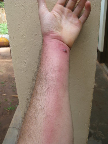 spider bite rash pictures. Above: The ite and the rash