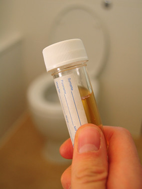 HCG, cancer screening, cancer detection, urine specimen, urine sediment