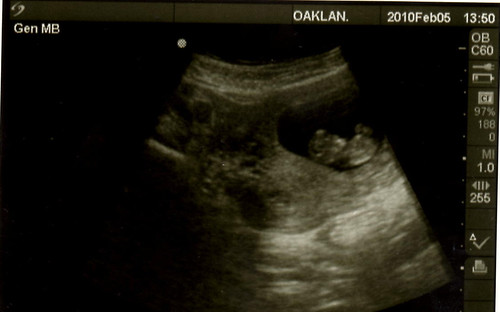 ultrasound 10 weeks