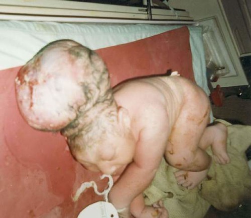 depleted uranium baby images. Depleted Uranium Baby