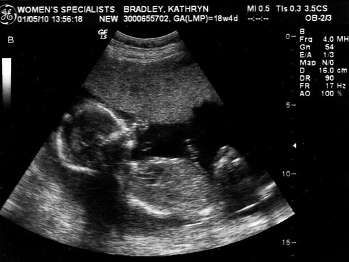 Baby B profile - 18 weeks