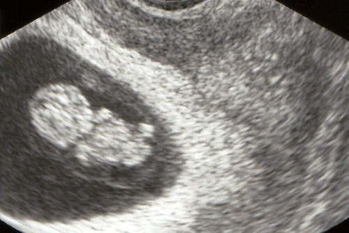 9 weeks pregnant. 9 weeks ultrasound