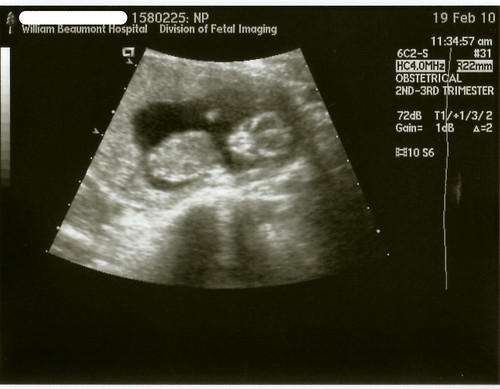 ultrasound 12 weeks 3