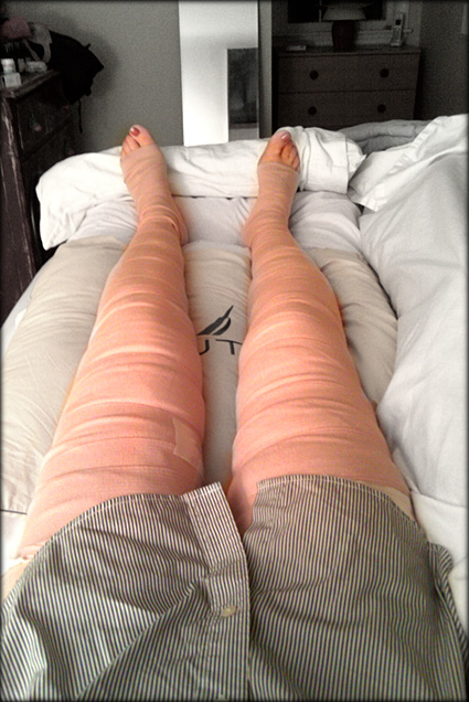 iambossy-surgery-legs