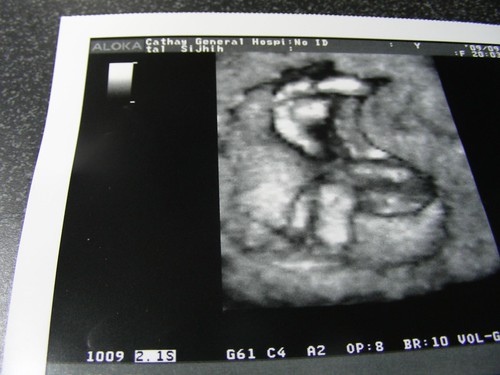 [好孕]16週3D超音波