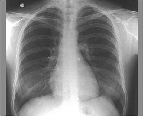 X Rays Of Pneumonia