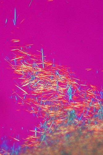 Monosodium Urate Crystals in