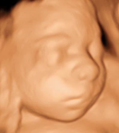 3d ultrasound pictures at 26 weeks. 3D Sono Image | 3D Ultrasound