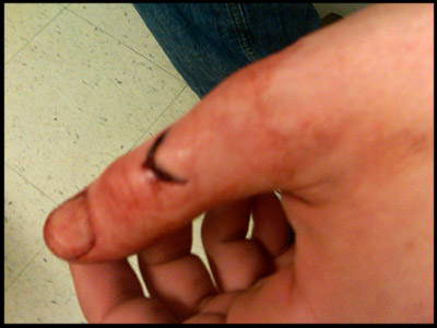 cut-finger-accident