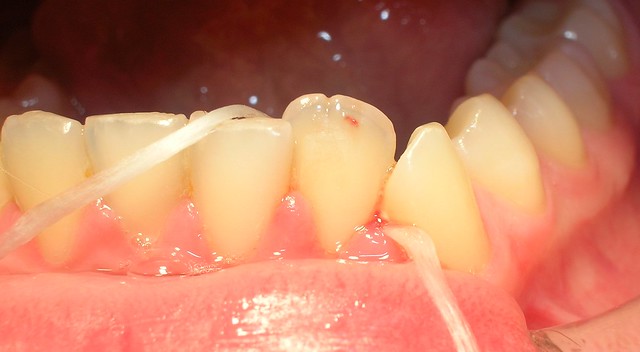 Cinta dental dientes inferiores